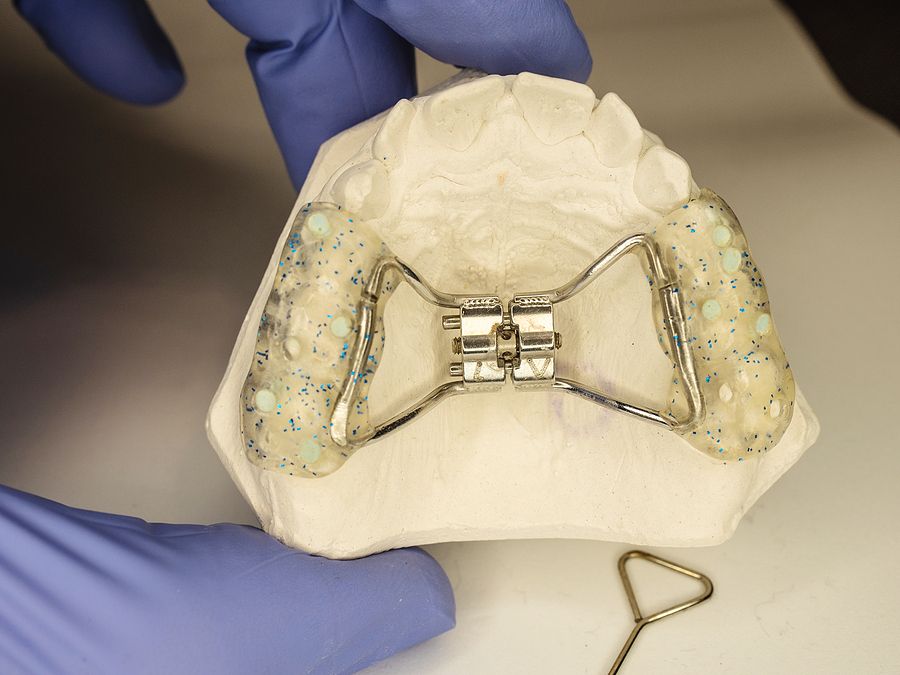 Unlocking Smiles: The Role of Expanders in Orthodontic Treatment