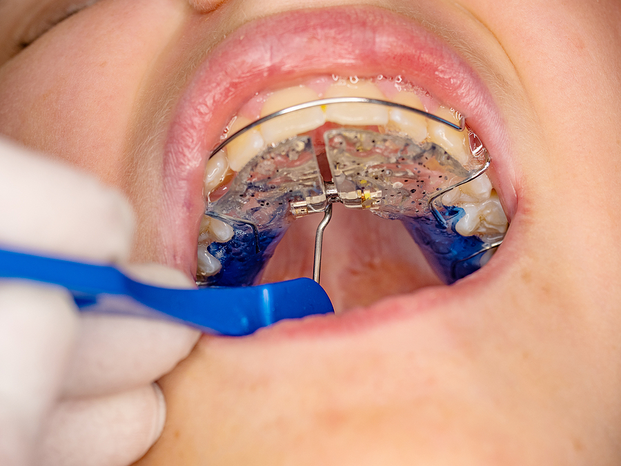 A Comprehensive Guide to Dental Expanders in Oklahoma City & Kingfisher, OK