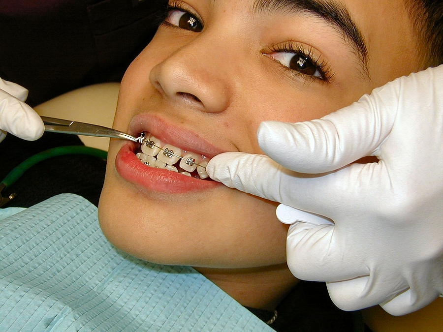 Transform Your Smile with Overbite Correction in Oklahoma City & Kingfisher, OK