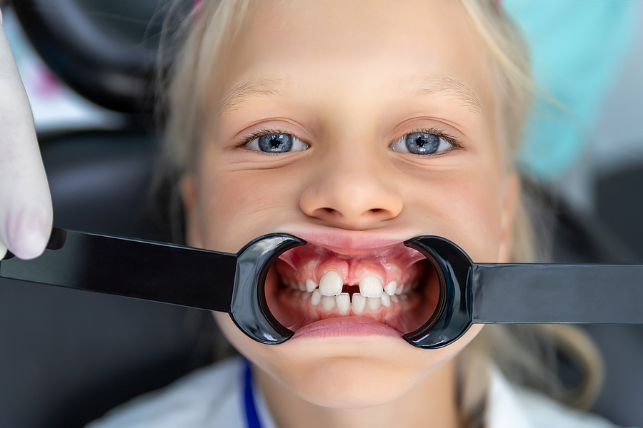 Achieving a Healthy Smile: Overbite Correction Options in Oklahoma City & Kingfisher, OK