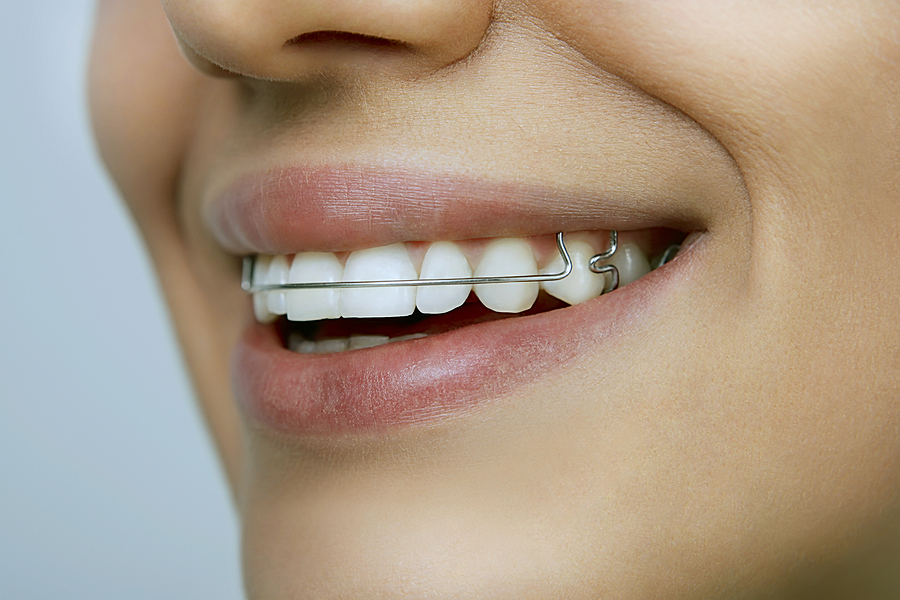 The Importance of Retainers in Oklahoma City & Kingfisher, OK: Ensuring Long-Term Orthodontic Success